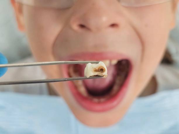 Best Chipped Tooth Repair Near Me  in Larned, KS